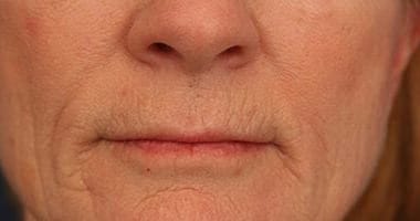 Before Image: Laser Resurfacing - front