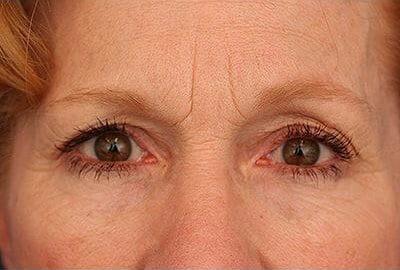 Before Image: Laser Resurfacing - front