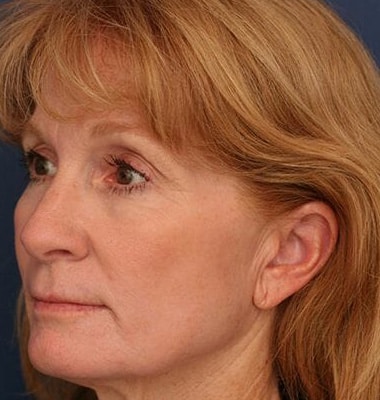 After Image: Laser Resurfacing - left-front-oblique