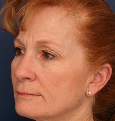 Before Image: Laser Resurfacing - left-front-oblique