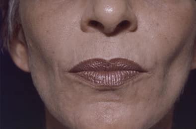 After Image: Laser Resurfacing - front