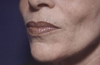 After Image: Laser Resurfacing - left-front-oblique