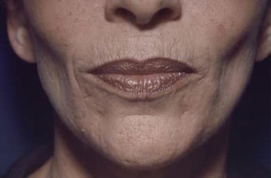 Before Image: Laser Resurfacing - front