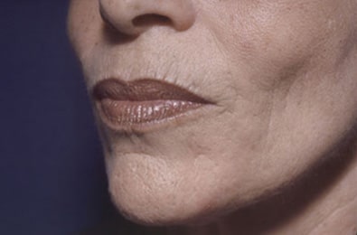 Before Image: Laser Resurfacing - left-front-oblique