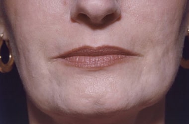 After Image: Laser Resurfacing - front