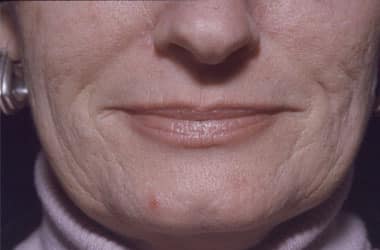 Before Image: Laser Resurfacing - front
