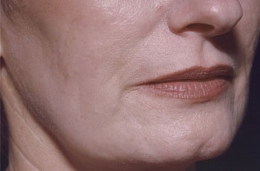 After Image: Laser Resurfacing - right-front-oblique