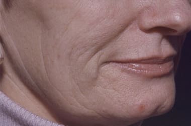 Before Image: Laser Resurfacing - right-front-oblique