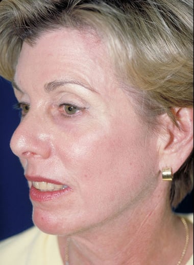 After Image: Laser Resurfacing - left-front-oblique