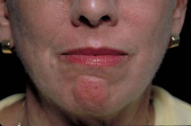 After Image: Laser Resurfacing - front