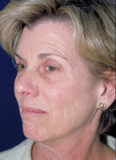 Before Image: Laser Resurfacing - left-front-oblique
