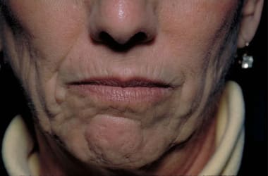 Before Image: Laser Resurfacing - front