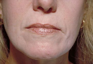 After Image: Laser Resurfacing - front