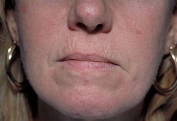 Before Image: Laser Resurfacing - front