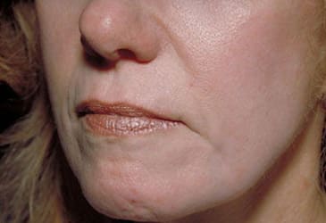 After Image: Laser Resurfacing - left-front-oblique