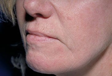 Before Image: Laser Resurfacing - left-front-oblique