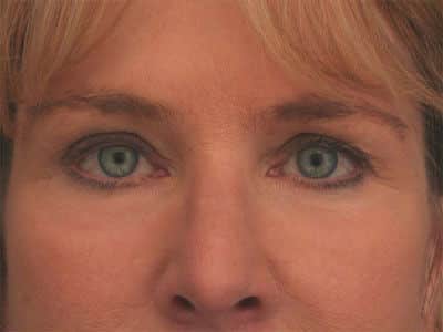 After Image: Laser Resurfacing - front