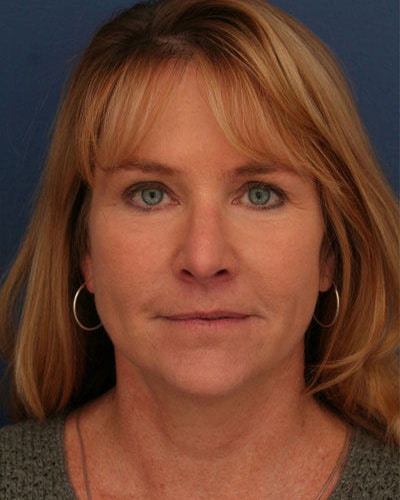 After Image: Laser Resurfacing - front