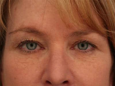 Before Image: Laser Resurfacing - front
