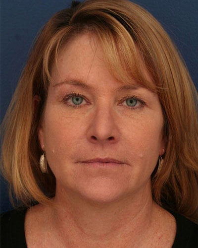 Before Image: Laser Resurfacing - front