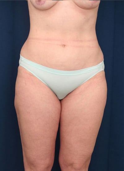 After Image: Liposuction - front
