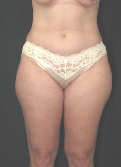 Before Image: Liposuction - front