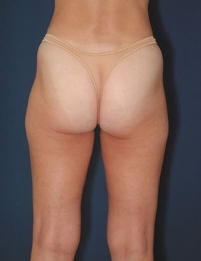 Before Image: Liposuction - back