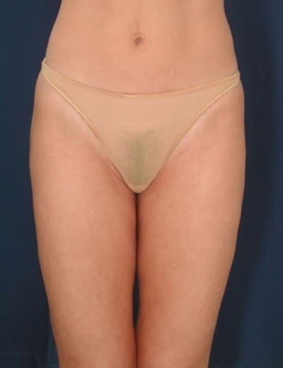 After Image: Liposuction - front