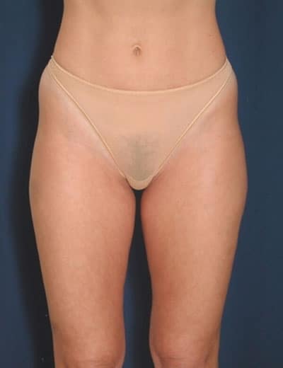Before Image: Liposuction - front