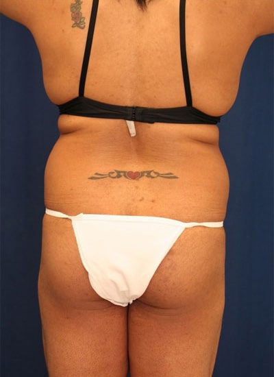 Before Image: Liposuction - back