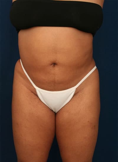 After Image: Liposuction - front