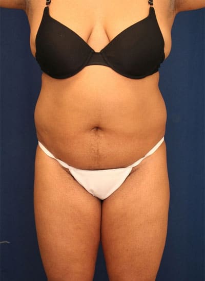 Before Image: Liposuction - front