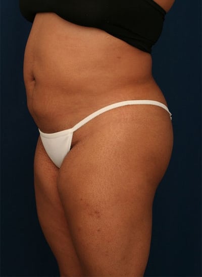 After Image: Liposuction - left-front-oblique