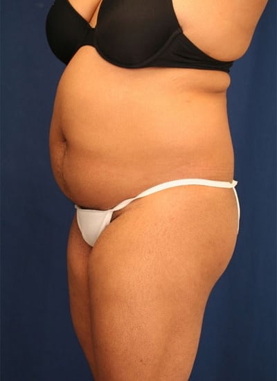 Before Image: Liposuction - left-front-oblique
