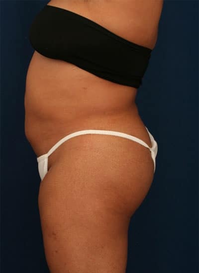 After Image: Liposuction - left-side