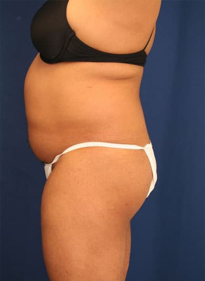 Before Image: Liposuction - left-side