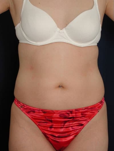 Before Image: Liposuction - front