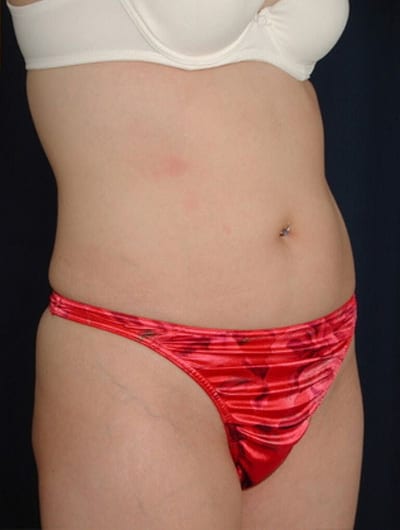 Before Image: Liposuction - right-front-oblique