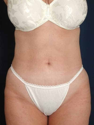 After Image: Liposuction - front
