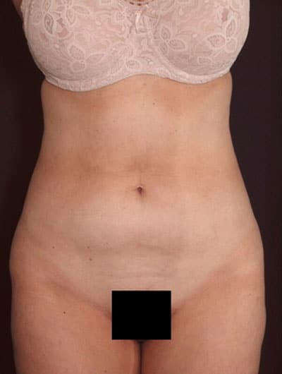 Before Image: Liposuction - front