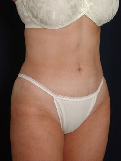 After Image: Liposuction - right-front-oblique