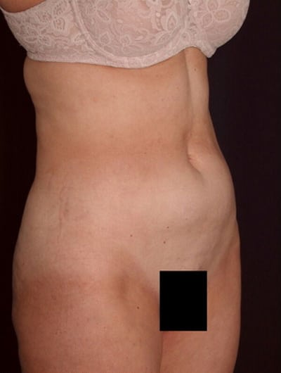 Before Image: Liposuction - right-front-oblique
