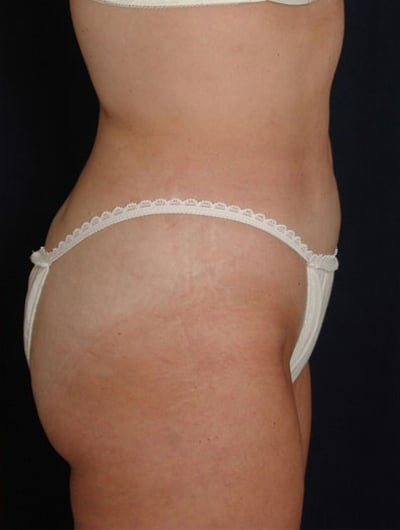 After Image: Liposuction - right-side