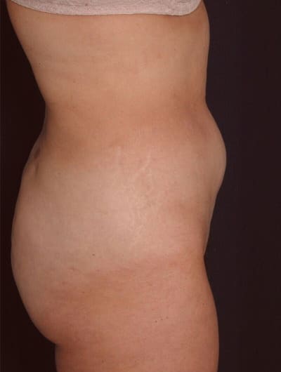 Before Image: Liposuction - right-side