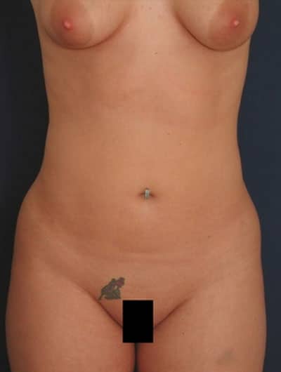 After Image: Liposuction - front