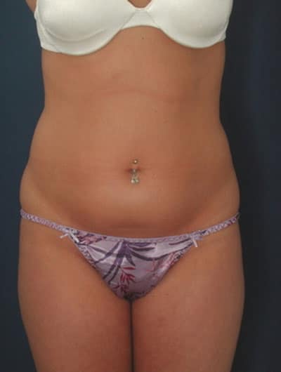 Before Image: Liposuction - front