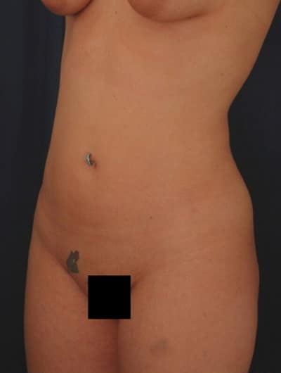 After Image: Liposuction - left-front-oblique