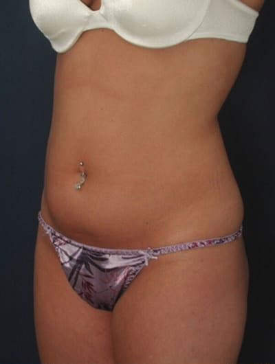 Before Image: Liposuction - left-front-oblique