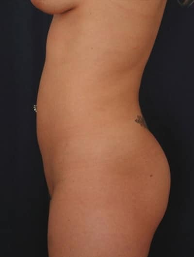 After Image: Liposuction - left-side