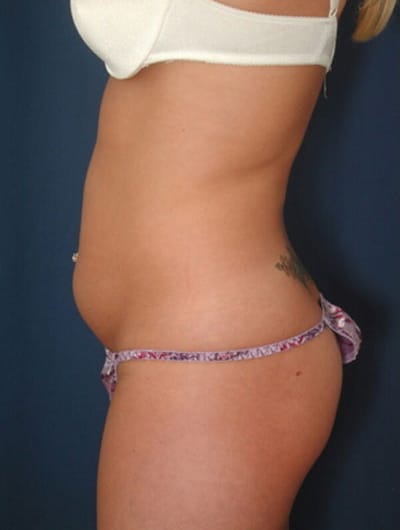 Before Image: Liposuction - left-side